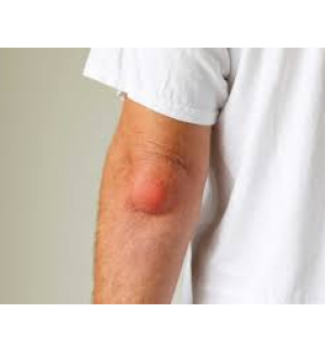 Schleimbeutelentzündung